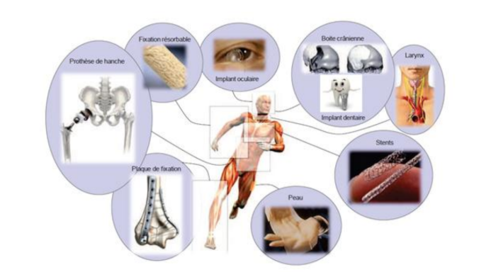 Les différentes prothèses du corps humain