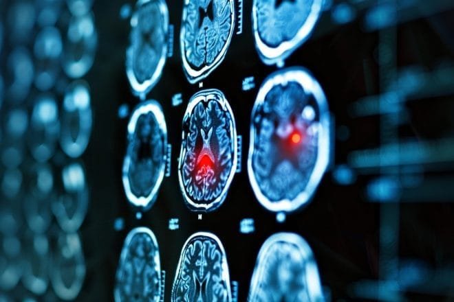 cerveau montrant une activité électrique anormale